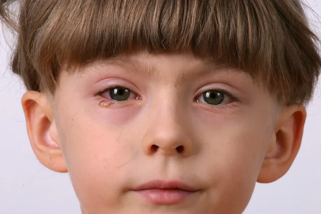 Pink Eye vs Allergy Eye, How to Tell the Difference